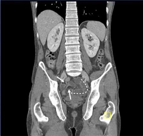Closed Loop Obstruction Of The Distal Small Bowel Due To Adhesions