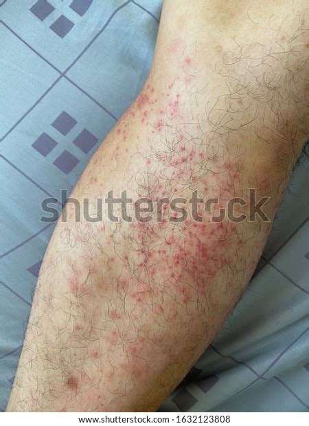 Atopic Dermatitis Rashes On Man Leg Stock Photo 1632123808 Shutterstock
