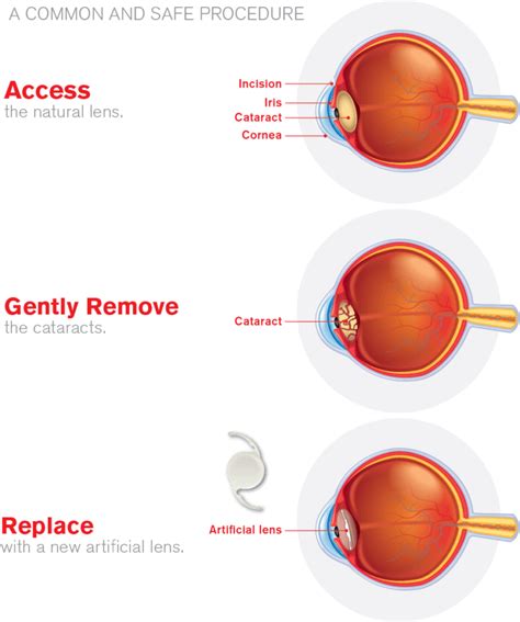 Cataract Surgery Short Hills Ophthalmology