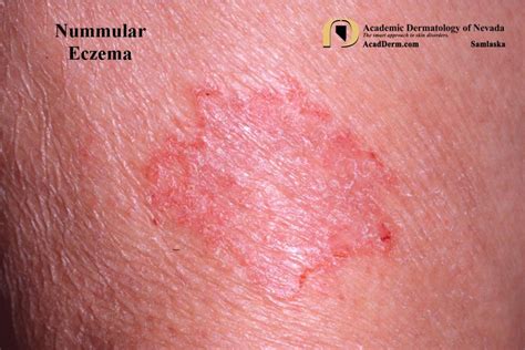 Nummular Eczema Academic Dermatology Of Nevada