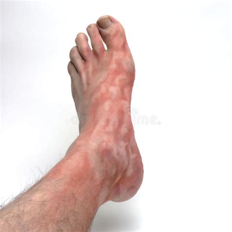 Types Of Foot Rashes How To Treat Them Causes Of Foot Rash Itchy Dry