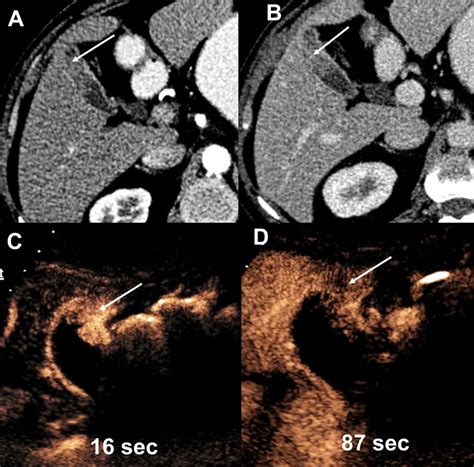 Adenomatous Polyp Arterial A And Venous B Phases Cect Images Show
