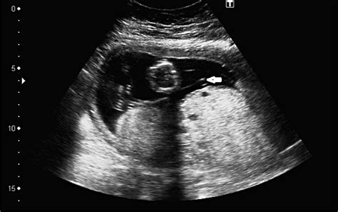 Complete Chorioamniotic Separation And Persistence Of A Yolk Sac