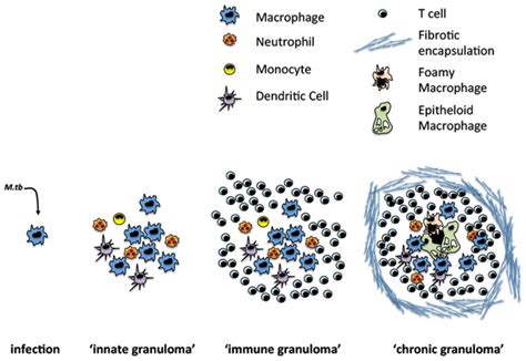 Evolution Of Tb Granuloma Formation Following Infection Sentinel
