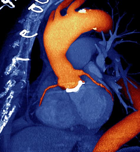 Prosthetic Heart Valve Photograph By Zephyrscience Photo Library Pixels
