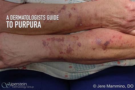 Understanding Purpura Begins With A Professional Dermatologist