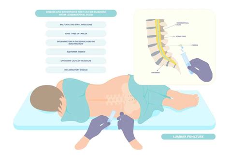 Pass Point Assisted Spinal Sonography An Ultrasound Guided Lumbar