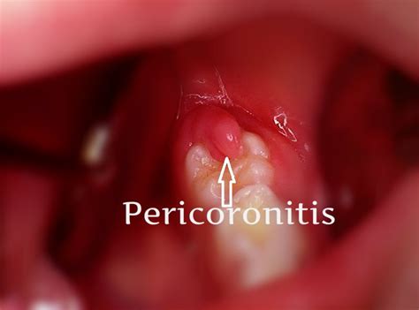 All You Need To Know About Pericoronitis Dr Sunil Dental Blog