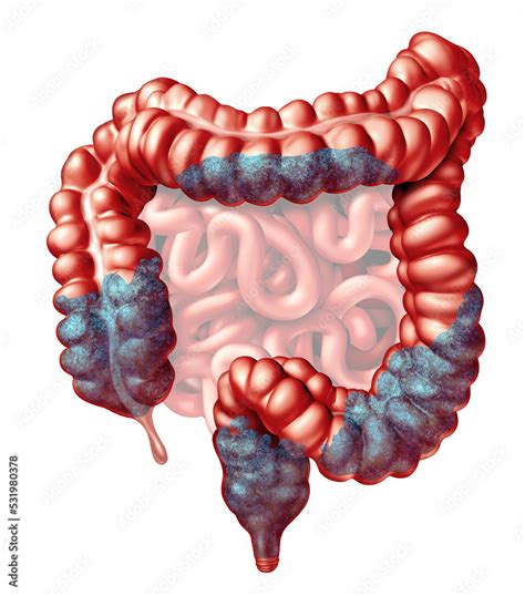 Constipation Anatomy And Constipated Symptoms As Stool Bowel Movement