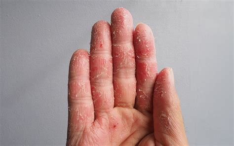 12 Reasons Why Your Fingertips May Be Peeling Skinkraft