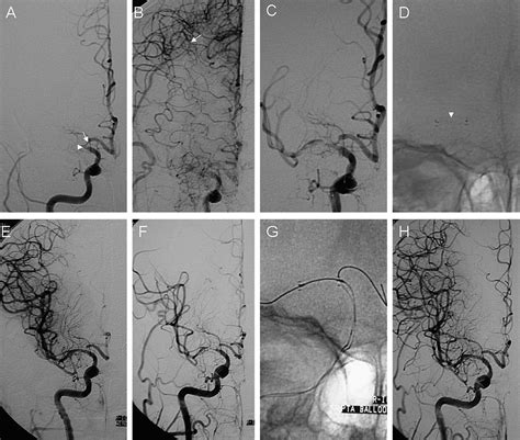 Endovascular Recanalization For Chronic Symptomatic Middle Cerebral Artery Total Occlusion