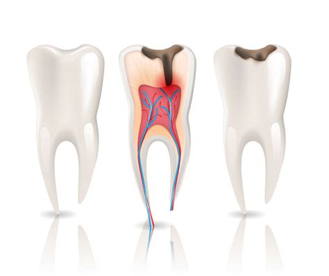 Group and individual dental plans to cover root canal treatment. Root-Canal-Therapy-ss | Safety Bay Dental Care Centre