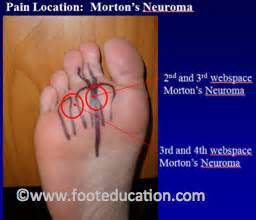Maybe you would like to learn more about one of these? Morton's Neurom 3 - fussInfofussInfo.com