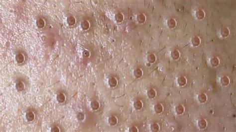 Amazing Fat Blackheads Popping Awesome Popping With Mr Dali 34