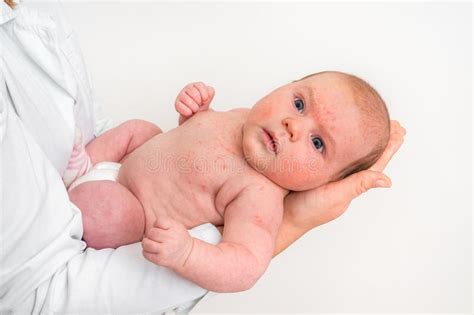 Newborn Baby With Skin Rash Allergic Reaction After Birth Stock Image