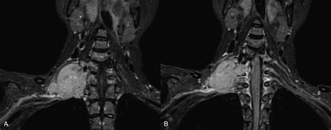 Sarcoma Of The Right Brachial Plexus 3 Dimensional Stir Space
