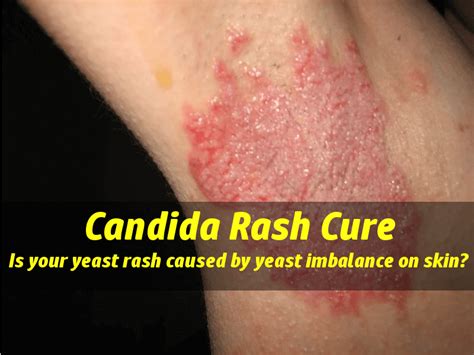 Candida Skin Rash Images