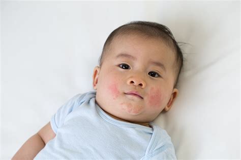 Obat Alergi Anak Yang Aman Dan Sesuai Gejala Alerginya Bukareview