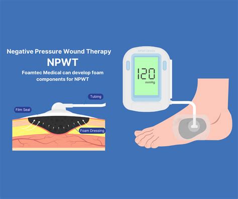 Use Of Foam In Negative Pressure Wound Therapy Npwt Foamtec Medical