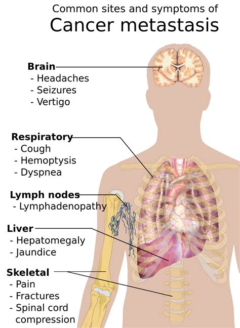 Symptoms of lung cancer develop as the condition progresses and there are usually no signs or symptoms in the early stages. Cancer signs and symptoms - Wikipedia