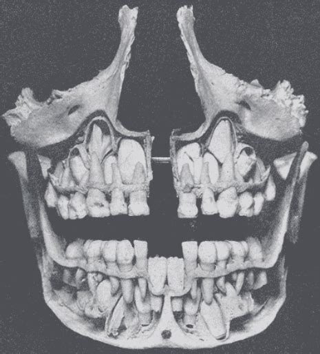 X Rays Of Kids Skulls As Their Baby Teeth Get Pushed Out And Their
