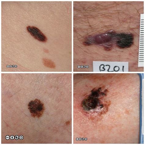 Fico 28 Fatti Su Melanoma Skin Cancer Symptoms Medically Reviewed By