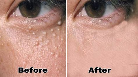 5 Minutes To Remove All Milia On Your Face At Home Remedies Health