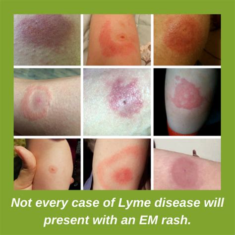 Identifying Lyme Disease Rash