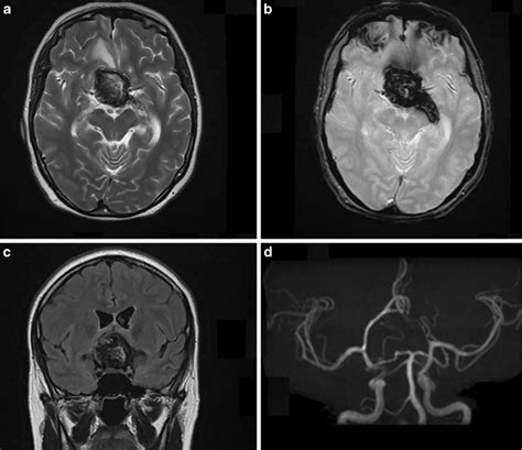 Axial T2 A And Coronal T2 Flair C Weighted Sequence From An Mri