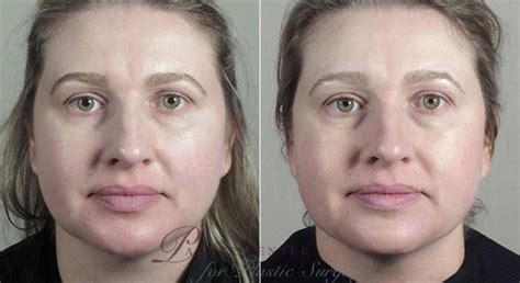 Nonsurgical Face Procedures Before And After Pictures Case 311