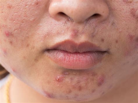 What Is It Perioral Dermatitis Vs Acne Balmonds