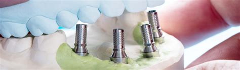 What Are The Dental Implant Healing Stages Dentakay