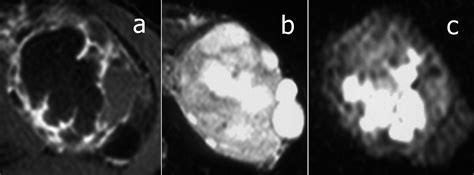 Diffusion Weighted Magnetic Resonance Imaging Of Infected Renal Cysts In A Patient With