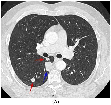 Jof Free Full Text Differentiating Lung Nodules Due To Coccidioides
