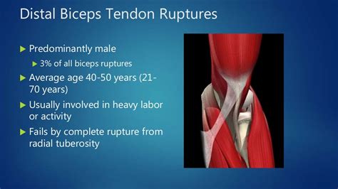 Distal Biceps Tendon Ruptures Elbow Tendinopathies South Windsor