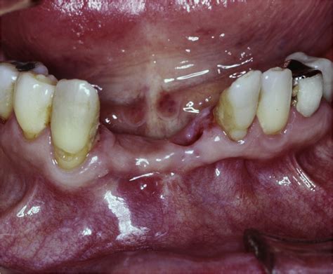 Glandular Odontogenic Cyst—a Case Series Journal Of Oral And