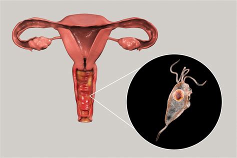 Trichomonas Vaginitis Discharge