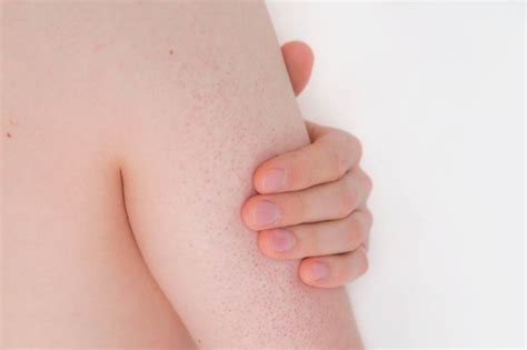 Skin Conditions That Look Like Acne Readers Digest