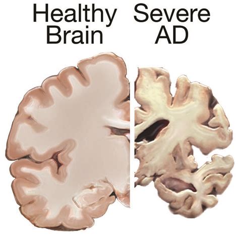 Nervous System Alzheimers Disease And Strokes Classroom Partners