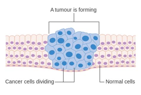 Difference Between Tumor And Cancer Definition Treatment Options