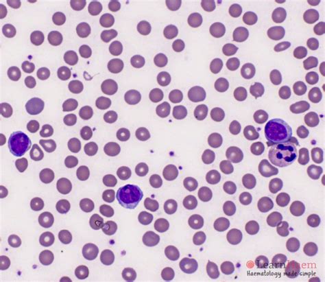 B Prolymphocytic Leukaemia Learnhaem Haematology Made Simple