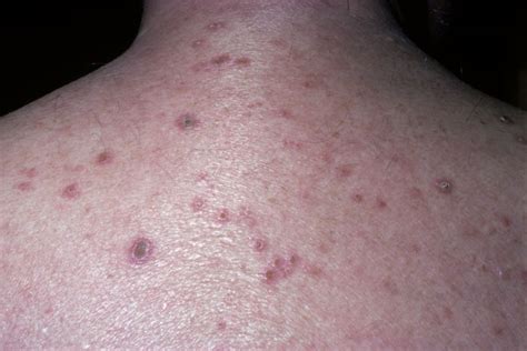 Derm Dx An Elderly Man With Multiple Intensely Itchy Dark Red Bumps
