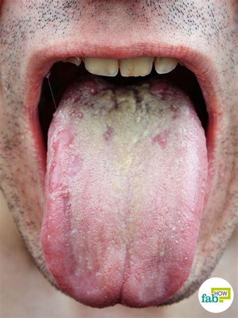 Leave it to absorb in your skin for 15 minutes. Thrush The Mouth - Transsexual Women