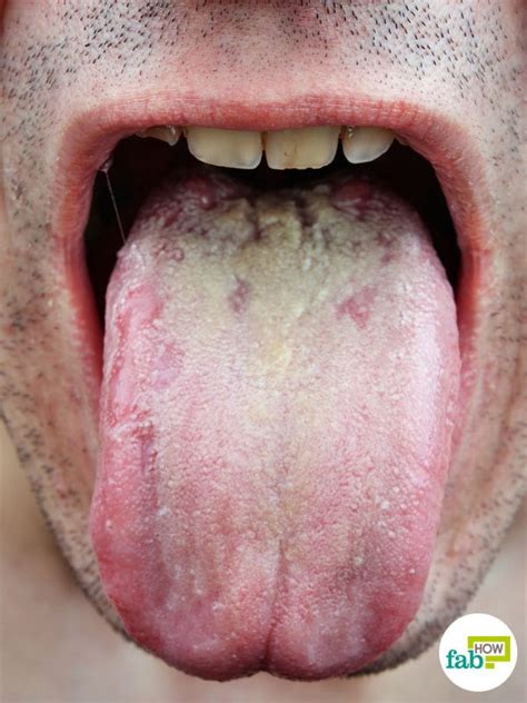 Treatment for thrush depends on the severity and the cause and can include simple home remedies. Thrush The Mouth - Transsexual Women
