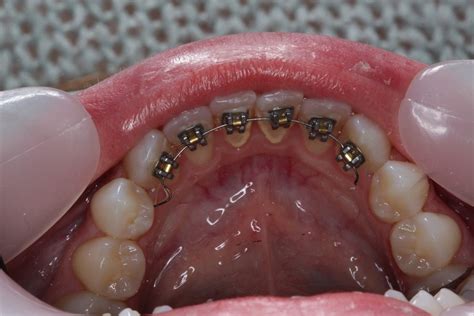 Behind Teeth Braces Advance Dental Care Cardiff
