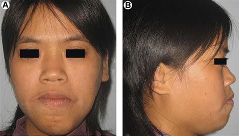 Sequential Treatment Of Giant Lymphatic Malformation Of The Tongue