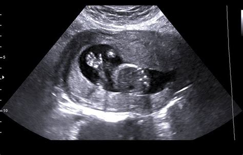 Pregnancy Ultrasounds 2d 3d 4d And 5d Hd