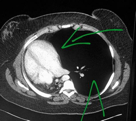 Chest Ct Scan In A Patient Who Was Born With Only One