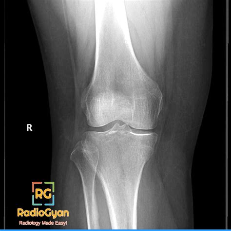 Schatzker Classification Of Tibial Plateau Fractures Radiogyan