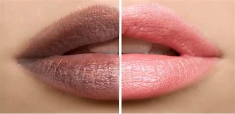 lighten dark lips before and after